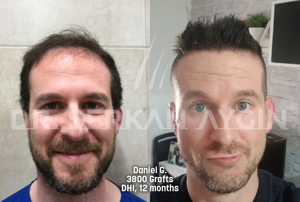 hair transplant before after photo