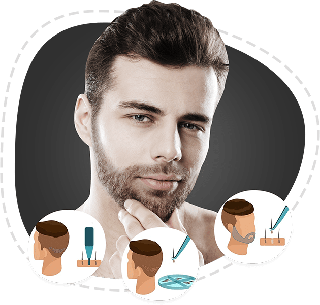 Beard Transplantation with DHI Technique